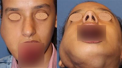 انقذوا الطفلة مريم.. قصة هاشتاج لمساعدة طفلة مريضة بورم بعد تعنت السفارة الألمانية (مستندات)