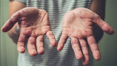 15 ألف إصابة بأمريكا.. خبراء يحذرون: اللقاحات ليست حلا سحريا لعدوى جدري القرود