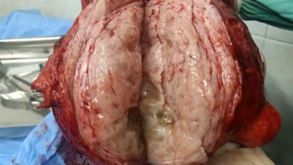 الورم الذي تم استئصاله