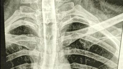 بسبب دبوس طرحه.. تعرض سيدة لانفجار في المرئ.. ومستشفى العبور بكفر الشيخ تعلن عن نجاح العملية 