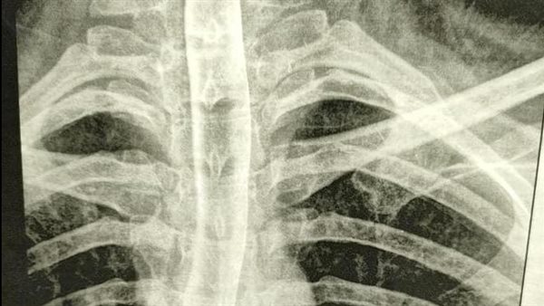 أشعة المريضة 