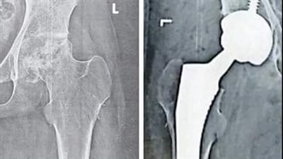 جراحة ناجحة لتغيير مفصل كامل لفخد طفلة بمنظومة التأمين الصحي الشامل ببورسعيد 