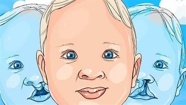 الشفة الأرنبية 