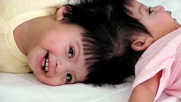 توأم ملتصق_ تعبيرية