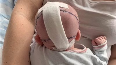 طبعوا نسخة من رأسها.. عودة رضيعة للحياة بعد خضوعها لجراحة دقيقة لبناء جمجمتها بتقنية ثلاثية الأبعاد 