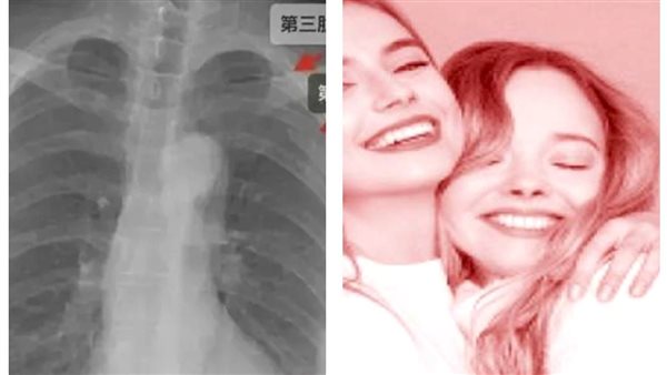 ضلوع الفتاة 