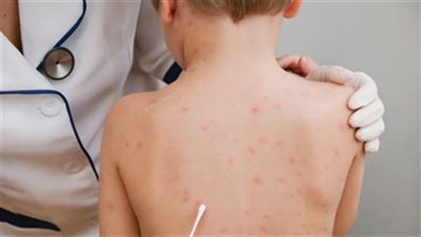 المكورات السحائية