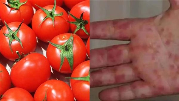 حمى الطماطم