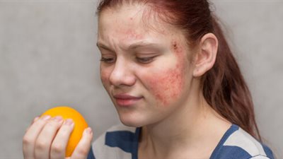  اكتشاف مركب بكتيري يساعد في علاج حساسية الطعام| دراسة