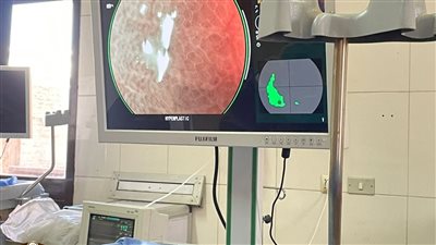 باستخدام الذكاء الاصطناعي.. نجاح إجراء مناظير قولون لـ 5 حالات بجامعة طنطا | صور