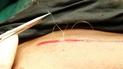 إصابة خمسيني بجرح قطعي في البطن في مشاجرة ببورسعيد.. والأمن يلاحق الجناه 