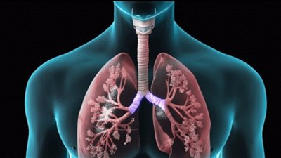 خبراء: 480 مليون شخص معرضون لخطر الإصابة بالانسداد الرئوي المزمن