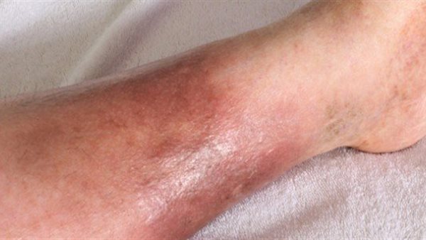 التهاب النسيج الخلوي