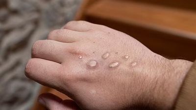 مسؤول صحي صيني يحذر من انتشار فيروس جدري القرود: لا تلمسوا الأجانب