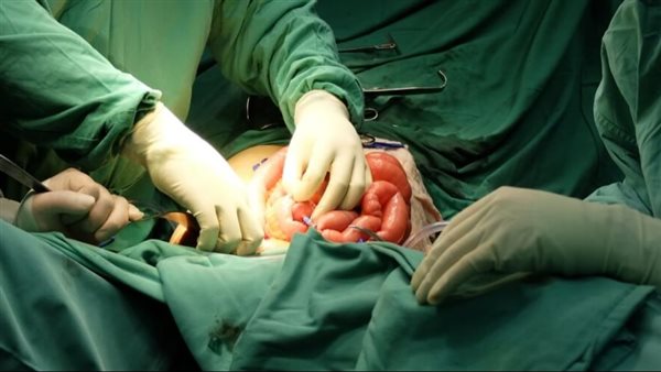 مستشفى صبياء العام ينجح في إنقاذ مريض بـ استئصال جزء من الأمعاء و القولون