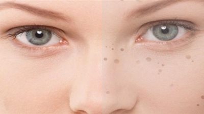 علاجات منزلية لتقليل البقع الداكنة في الجسم.. تعرف عليها
