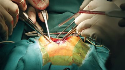 جراحة فاشلة.. زراعة فص كبد لرضيع يعاني من مرض نادر تتسبب له في مضاعفات جديدة