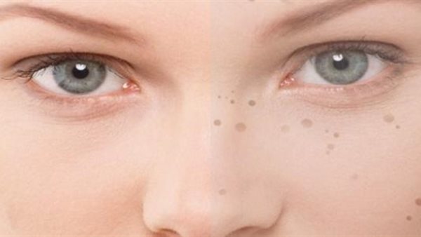 علاجات منزلية للبقع