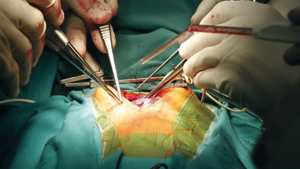 زراعة كبد -أرشيفية