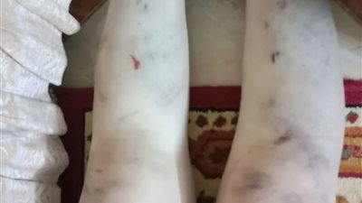 قطعوا جسمها وحرقوه.. طفلة تتعرض لاعتداء وحشي من والدها وزوجته ببورسعيد | صور