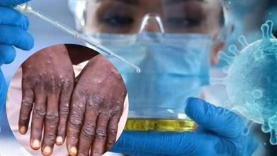 أمريكا تستعد لرفع إعلان الطوارئ بشأن فيروس جدري القرود