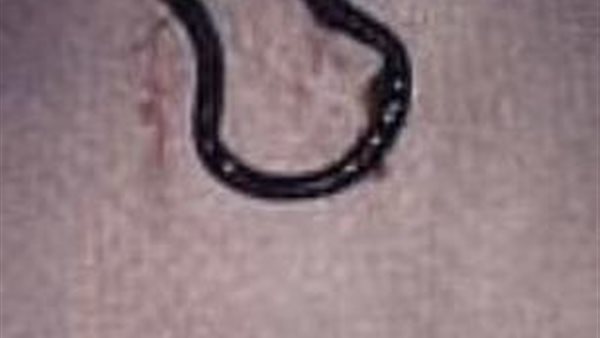 حلق أنف في رئة رجل