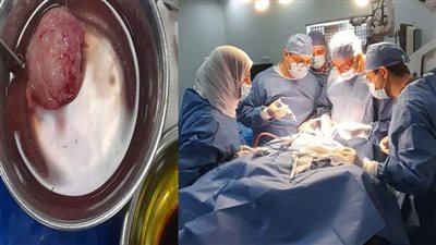 فريق طبي ينجح في استئصال ورم بالحنجرة الخلفية للمخ لطفلة بمستشفى الهلال للتأمين الصحي بسوهاج | صور 