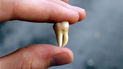  أطعمة يمكن تناولها بعد خلع ضرس العقل.. تعرف عليها