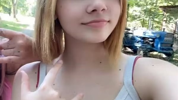 الفتاة المصابة بحساسية