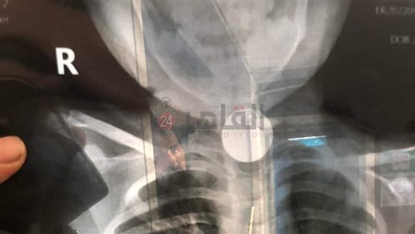ابتلاع طفل جنيه معدني