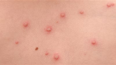 خبراء: الاستخدام طويل الأمد للكورتيكوستيرويدات يؤدي إلى إعادة تنشيط جدري الماء