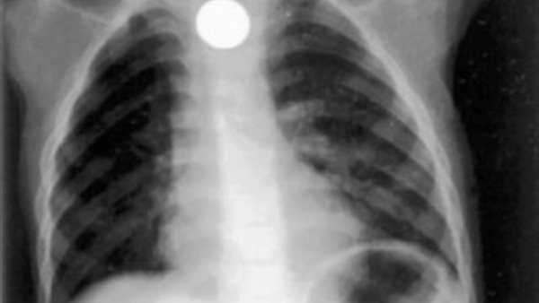 ابتلاع عملة معدنية