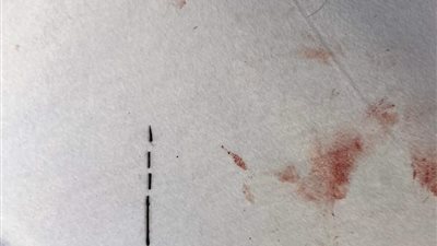 استقرت بجسده لمدة عامين.. استخراج إبرة تنجيد من ظهر مريض بمستشفى بنها الجامعي