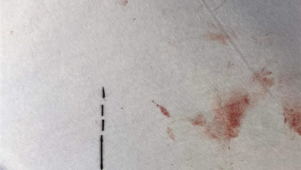 الإبرة المستخرجة