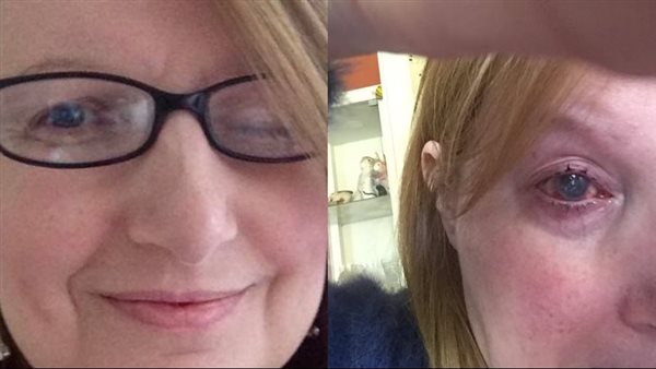 بريطانية تفقد عينها