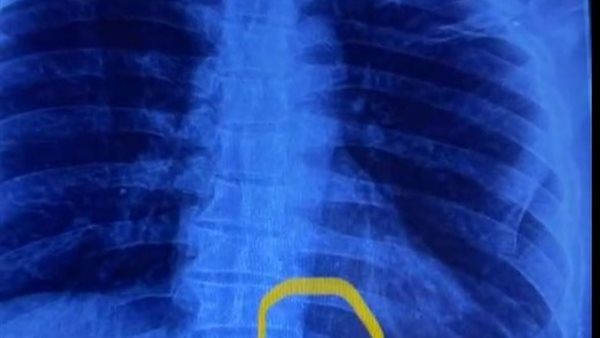 الابره في ظهر المريض