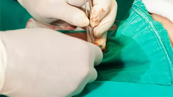 عملية ختان - أرشيفية