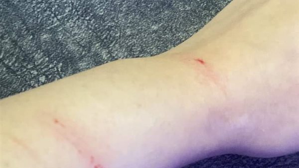 آثار تعدي والدها