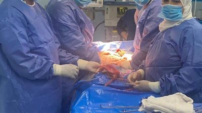 فريق طبي بمستشفى بنها التعليمي ينقذ حياة طفل باستئصال طحال متهتك إثر حادث تصادم 