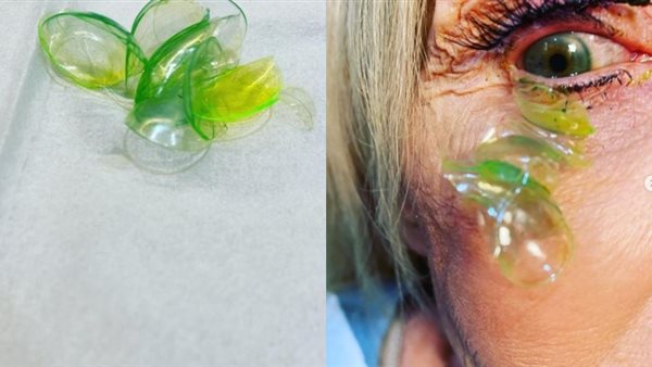 طبيبة تزيل 23 عدسة