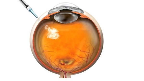 حقن العين- تعبيرية