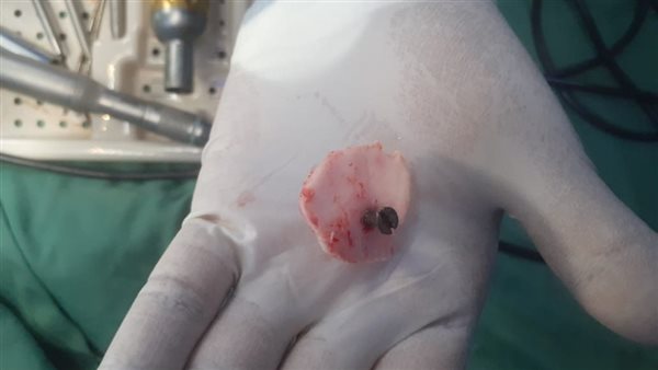 المسمار الذي تم استخراجه