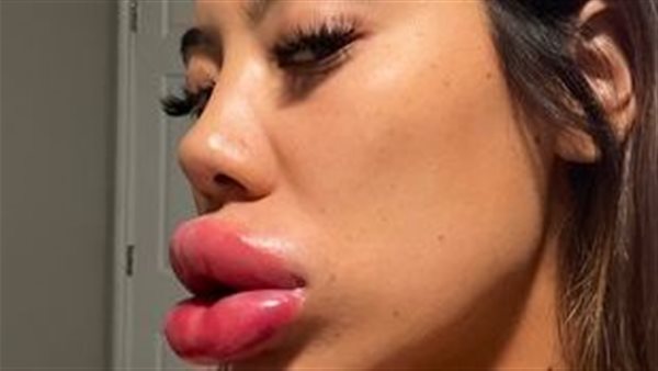 حقن بوتكس يتسبب في