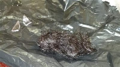 بعد معاناة 3 سنوات من السحر.. استخراج شعر وقطع زجاج من معدة سيدة بالأقصر| صور