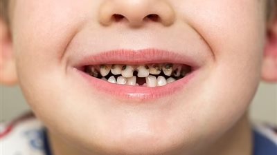 ديلي ميل: آلاف الأطفال يعانون من الأسنان المتعفنة بعد تكدس المستشفيات خلال جائحة كورونا