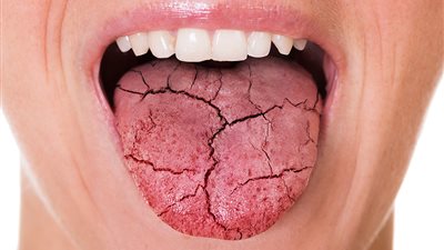  جفاف الفم علامة الإصابة بفيروس كورونا بنسبة 60%|دراسة 