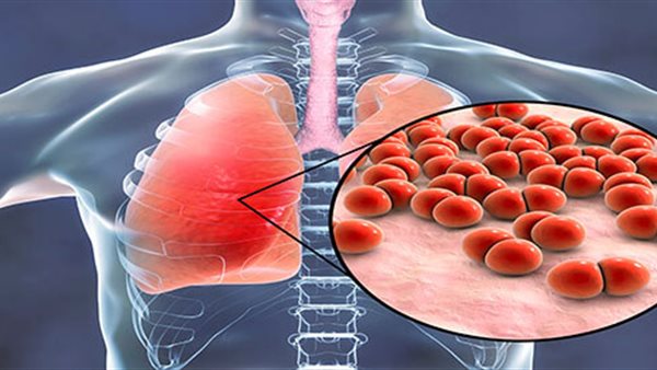 التهاب رئوي