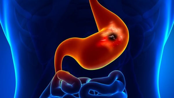 سرطان المعدة -تعبيرية