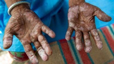 الصحة العالمية: نيجيريا تتسلم أدوية الجذام بعد تأخير لمدة عام