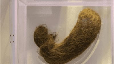 متلازمة ريبانزل..أطباء بومباي ينجحون في إزالة كرة شعر بحجم 1كجم من معدة فتاة 